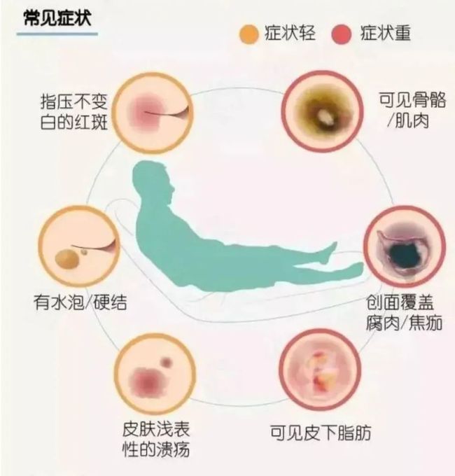 压疮分期最新详解，从创伤到康复的奋斗历程